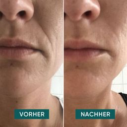 APRICOT Mund Pads mit Hyaluron