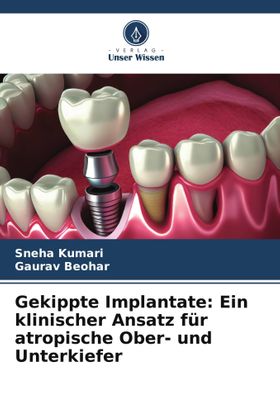 Gekippte Implantate: Ein klinischer Ansatz für atropische Ober- und Unterkiefer DE