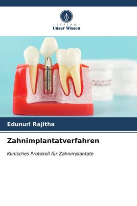 Zahnimplantatverfahren Klinisches Protokoll für Zahnimplantate