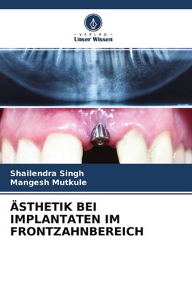 ÄSTHETIK BEI IMPLANTATEN IM FRONTZAHNBEREICH DE