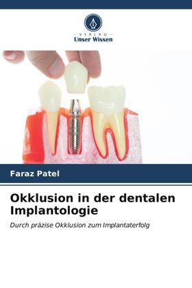 Okklusion in der dentalen Implantologie Durch präzise Okklusion zum Implantaterfolg