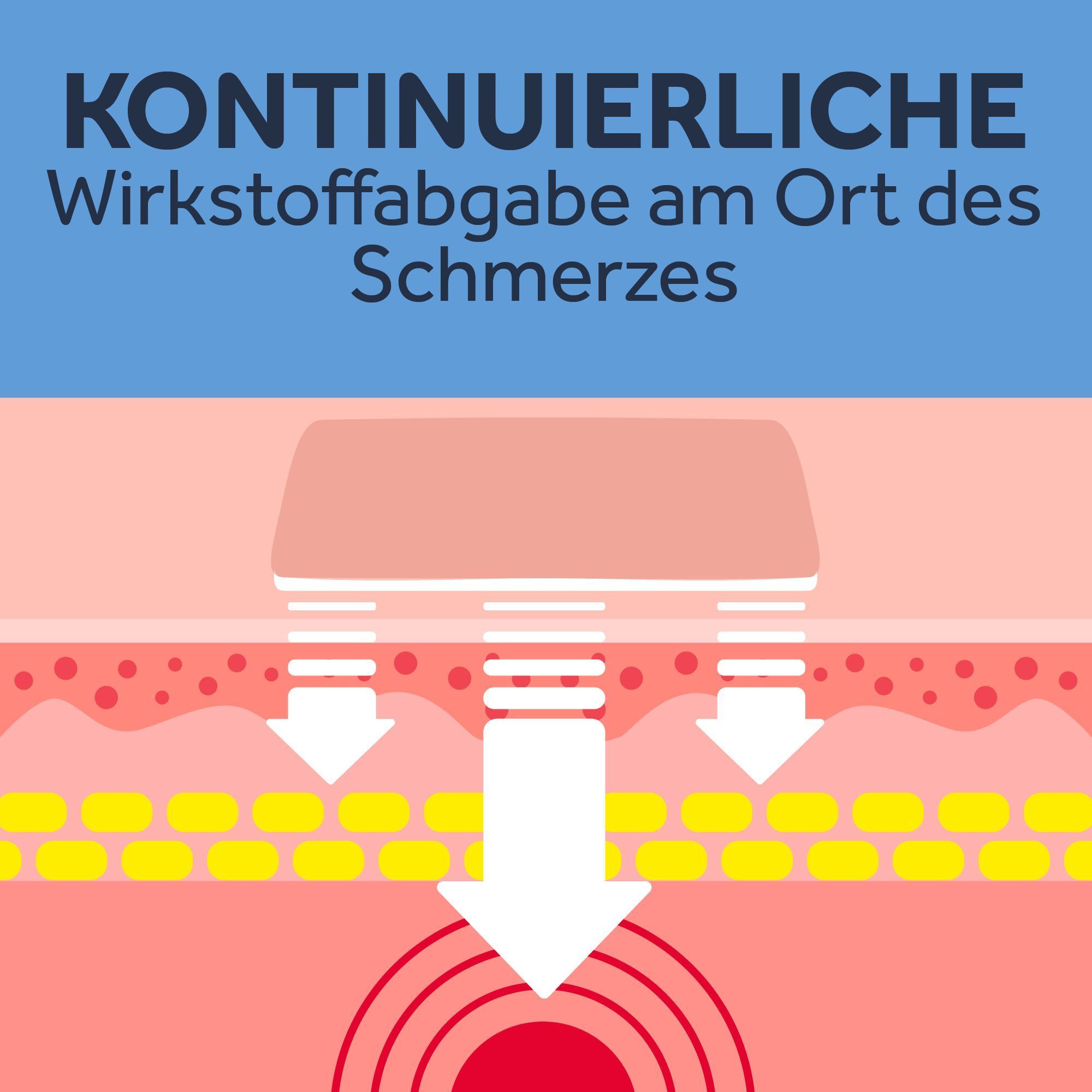 Schematische Darstellung der Wirkstoffabgabe eines Pflasters. Pfeile zeigen die Abgabe in die Haut.