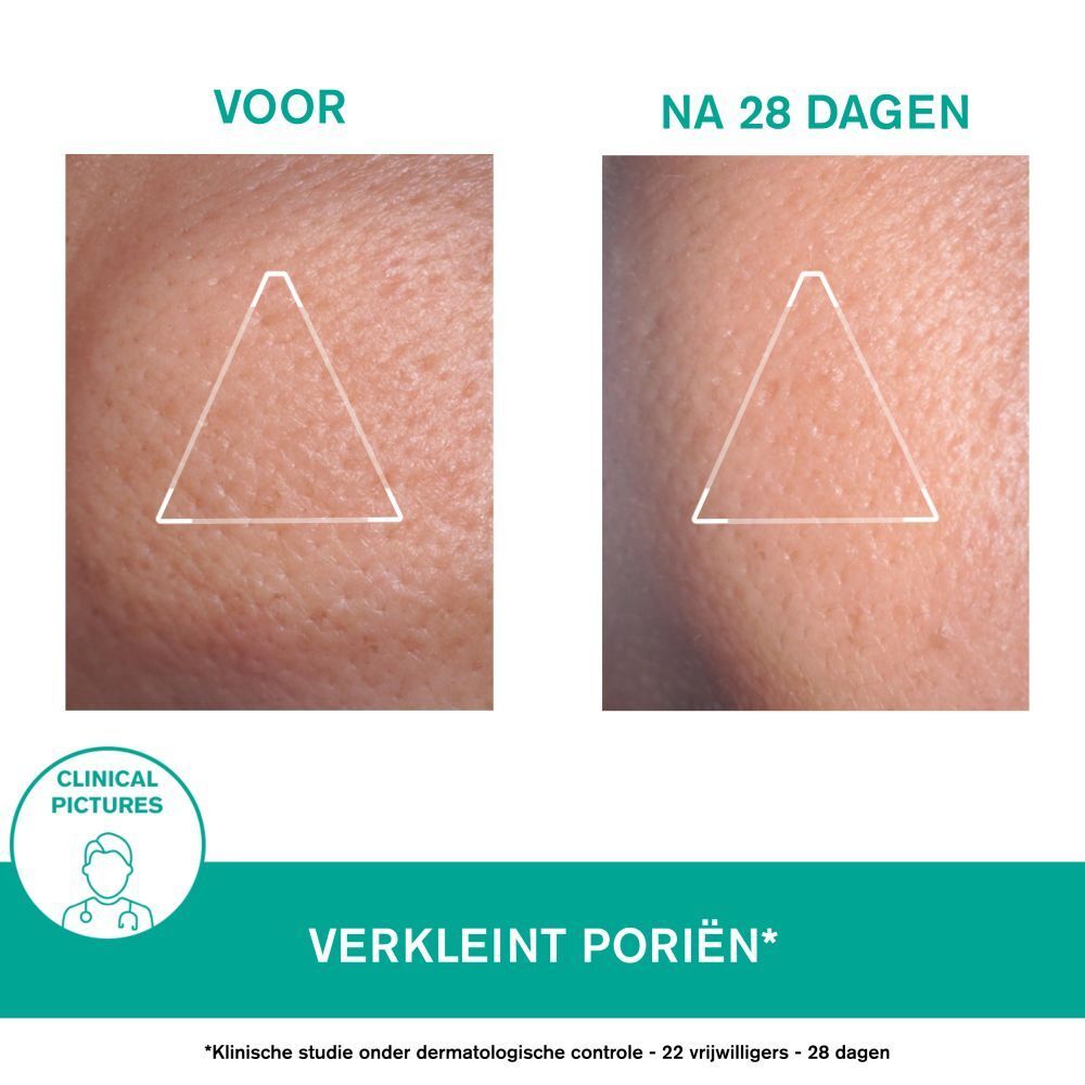 Afbeelding voor en na. Tekst: Verkleint poriën.