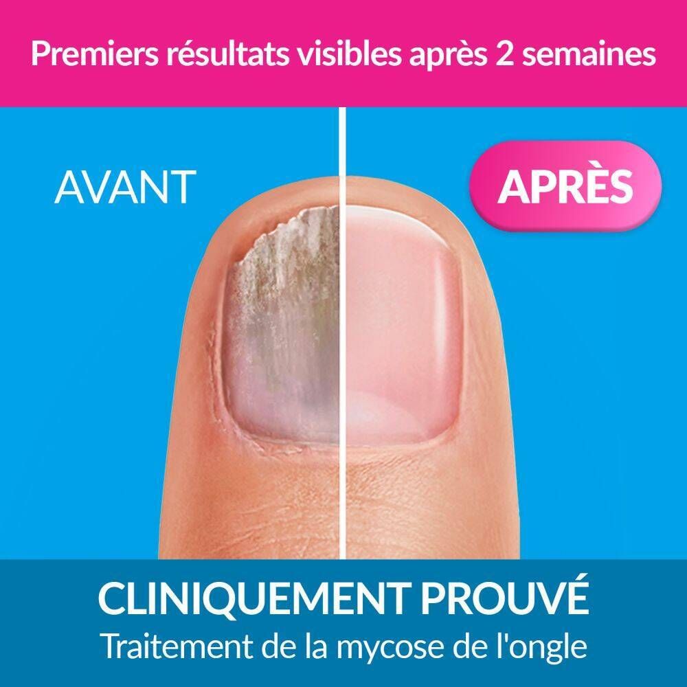 Trois emballages Excilor. Texte: Extra fort, pour les mycoses persistantes. Extra pratique.
