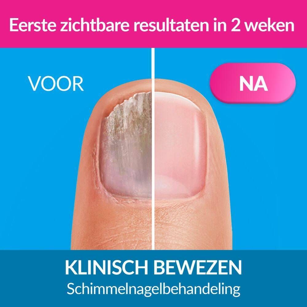 Drie Excilor verpakkingen. Tekst: Extra fort, pour les mycoses persistantes. Extra pratique.