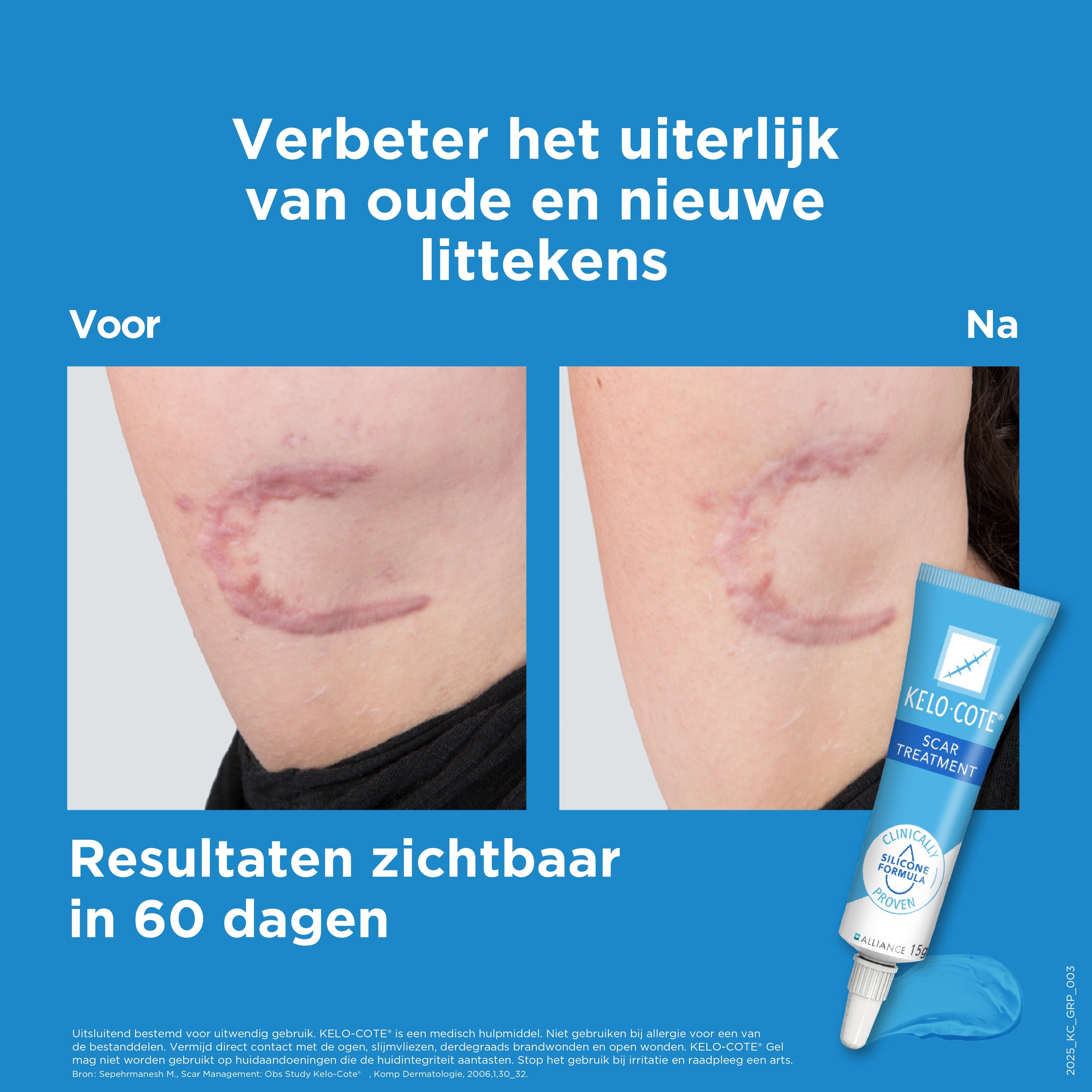 Voor- en na-afbeeldingen van littekens. KELO-COTE®-tube. Tekst: Resultaten in 60 dagen.
