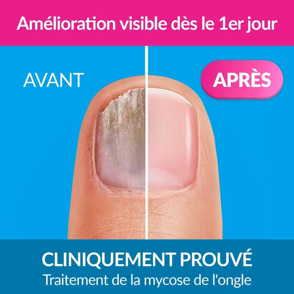 Emballage du produit. Exclior Forte. Traitement mycose des ongles. Flacon avec pinceau. Vue avant-après.