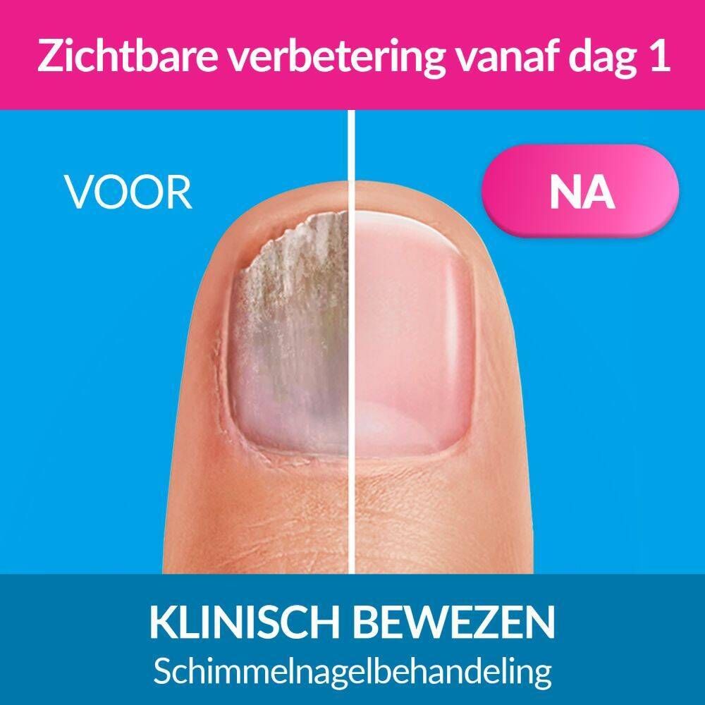Productverpakking. Exclior Forte. Schimmelnagel behandeling. Fles met borstel. Voor-na nagelweergave.