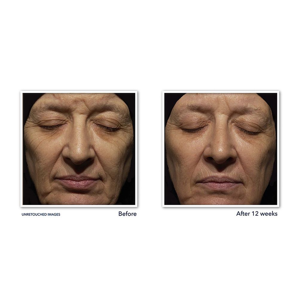Voor- en na foto's. Vrouwen gezichten. Tekst: Before, After 12 weeks.