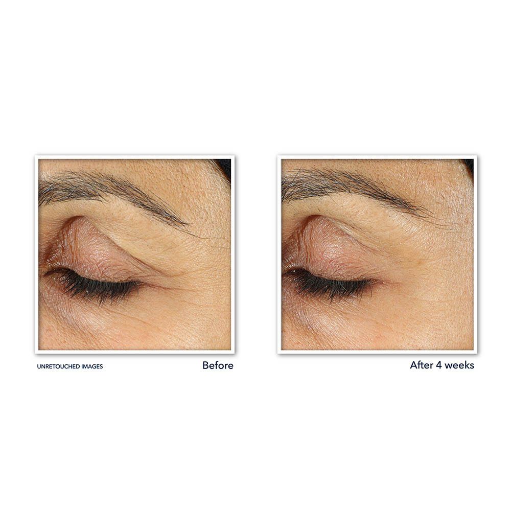 Image avant-après. Contour des yeux ridé. Après 4 semaines : moins de rides.