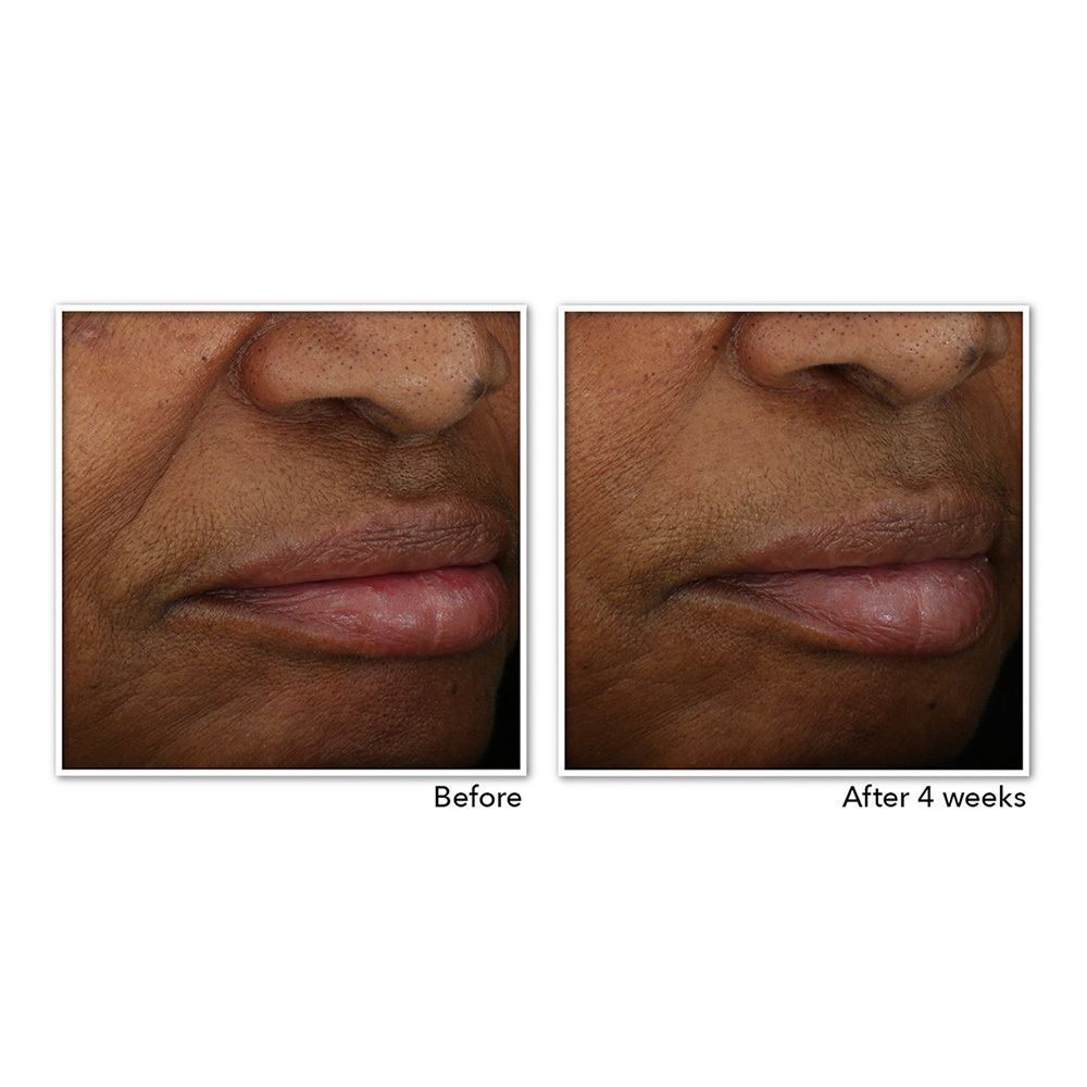 Voor en na foto's. Close-ups van lippen. Verbetering na 4 weken.
