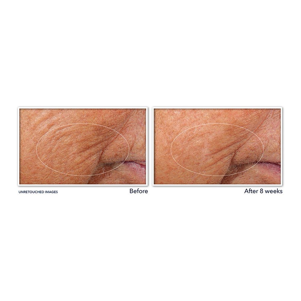Voor- en na-afbeeldingen van gezichtsrimpels. Ovale gebieden. Tekst: UNRETOUCHED IMAGES. Before/After 8 weeks.