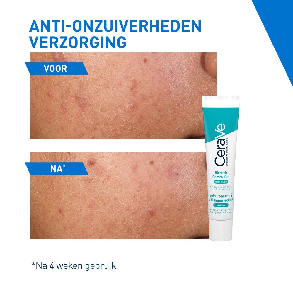 Voor-en-na vergelijking. Huid met onzuiverheden, dan verbeterde huid na 4 weken.