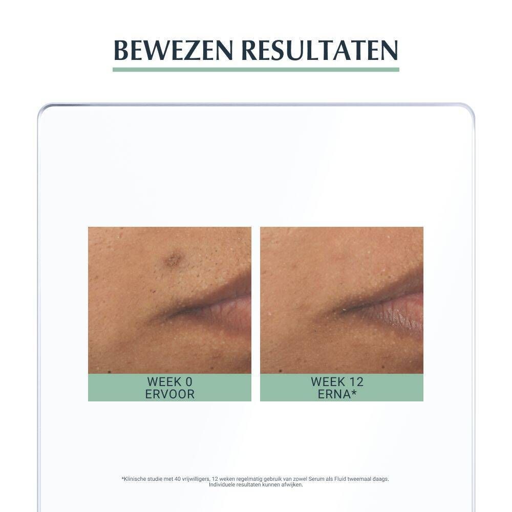 Voor- en na-afbeelding. Week 0 en week 12. Huid met minder onzuiverheden na gebruik van het serum.