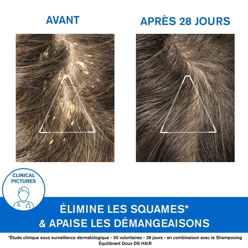 Images avant-après. Cuir chevelu avec squames avant et après 28 jours. Texte: Élimine les squames & apaise les démangeaisons.