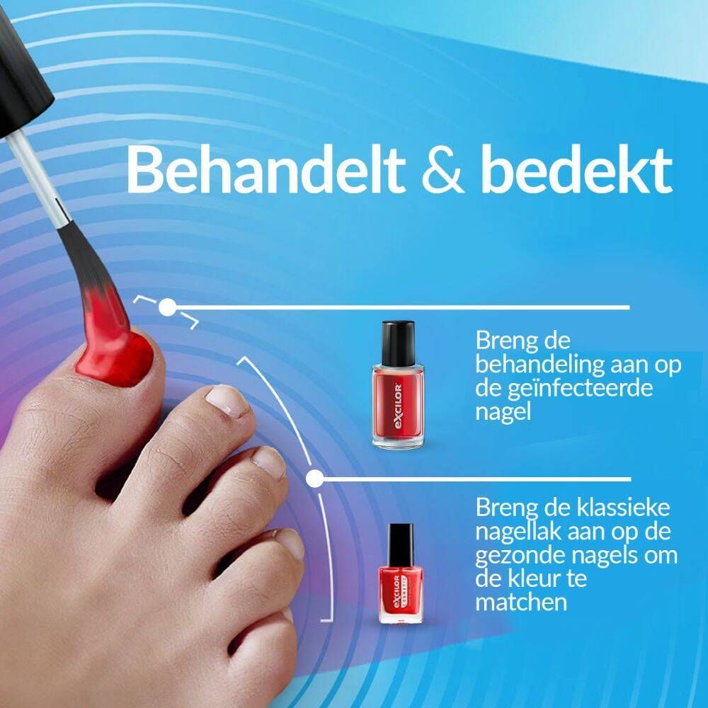 Behandeling schimmelnagels. Nagellakflessen. Toepassing op geïnfecteerde en gezonde nagels.