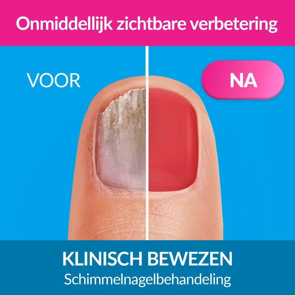 Voor/Na vergelijking. Aangetaste nagel. Klinisch bewezen. Behandeling schimmelnagels.