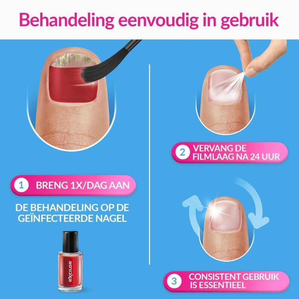 Excilor Forte, behandeling schimmelnagels. Koraalrood. Voor/Na. Klinisch bewezen.