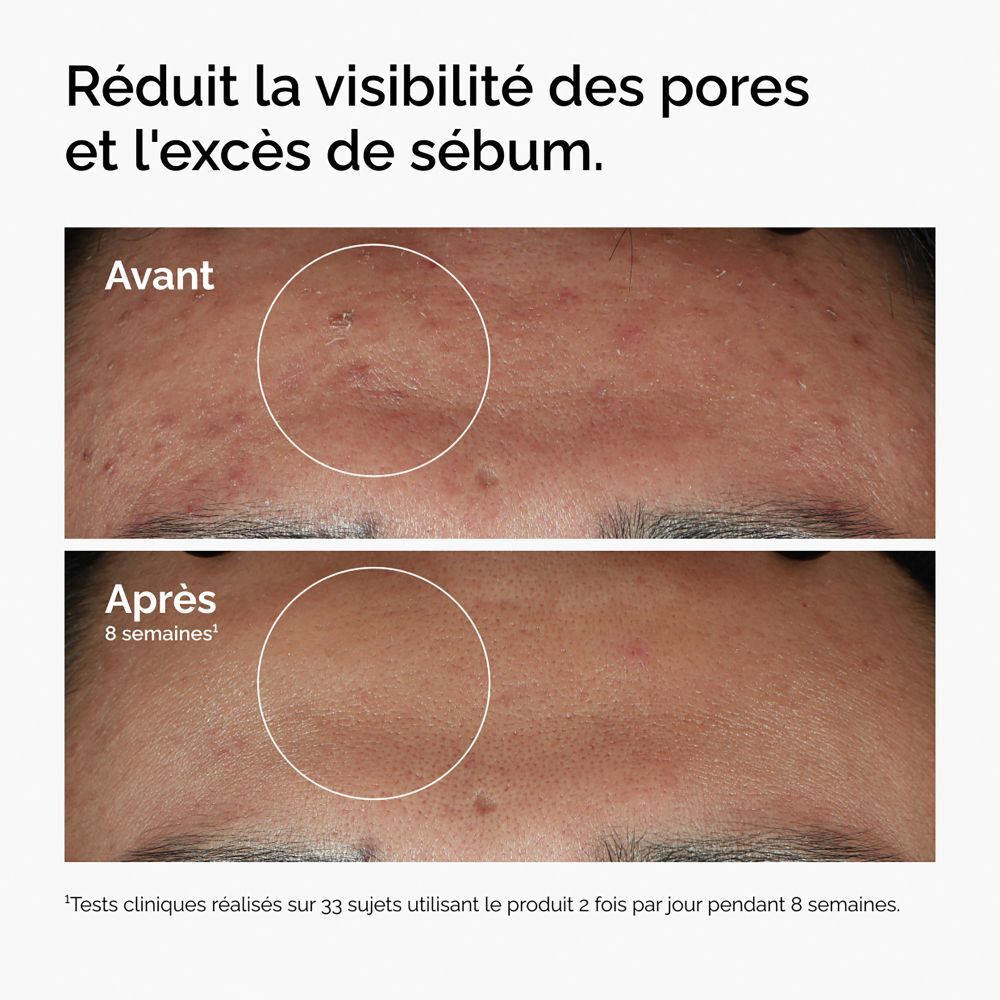 Comparaison avant-après. Peau avec boutons, puis peau plus lisse.