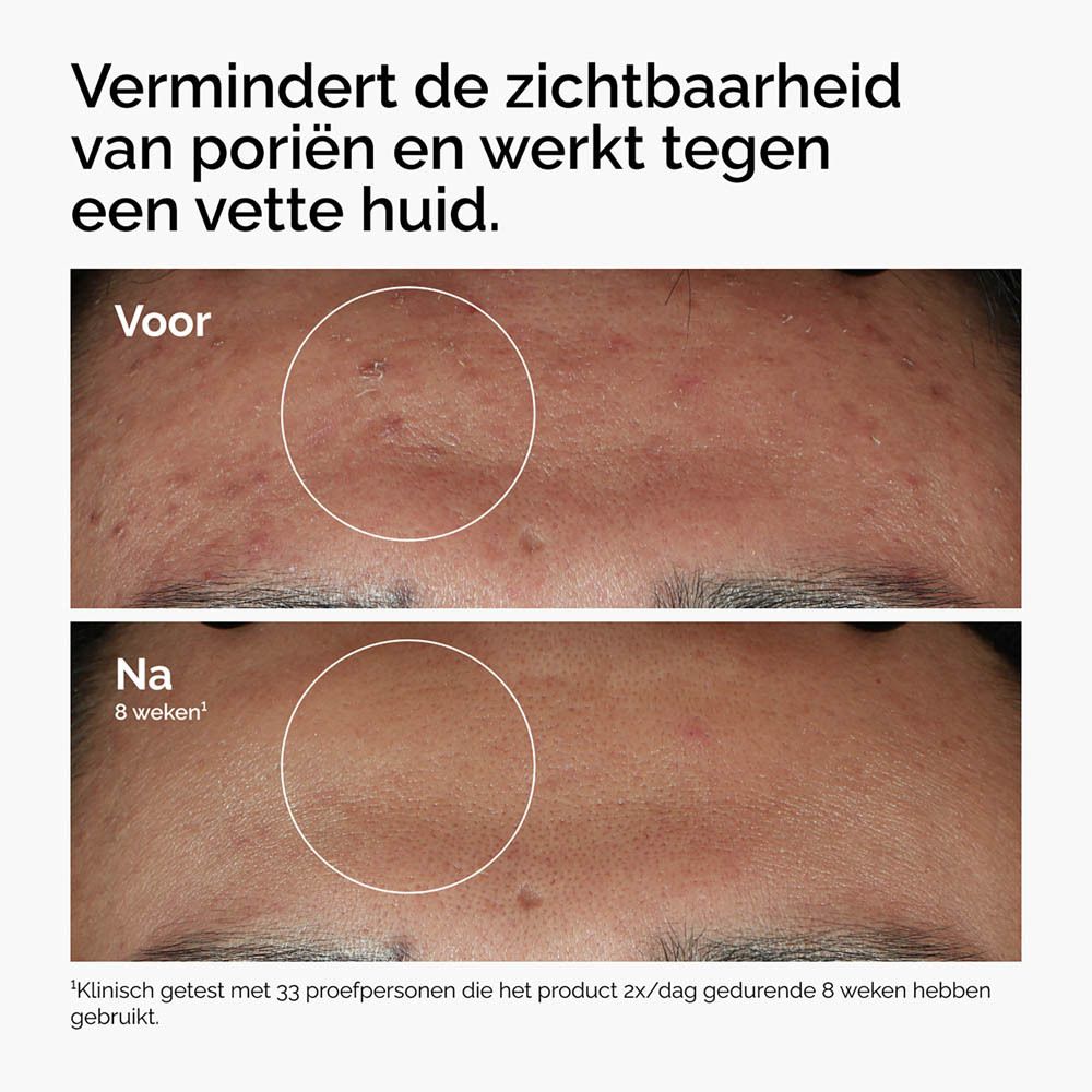 Voor- en na-vergelijking. Huid met puistjes, dan gladdere huid.