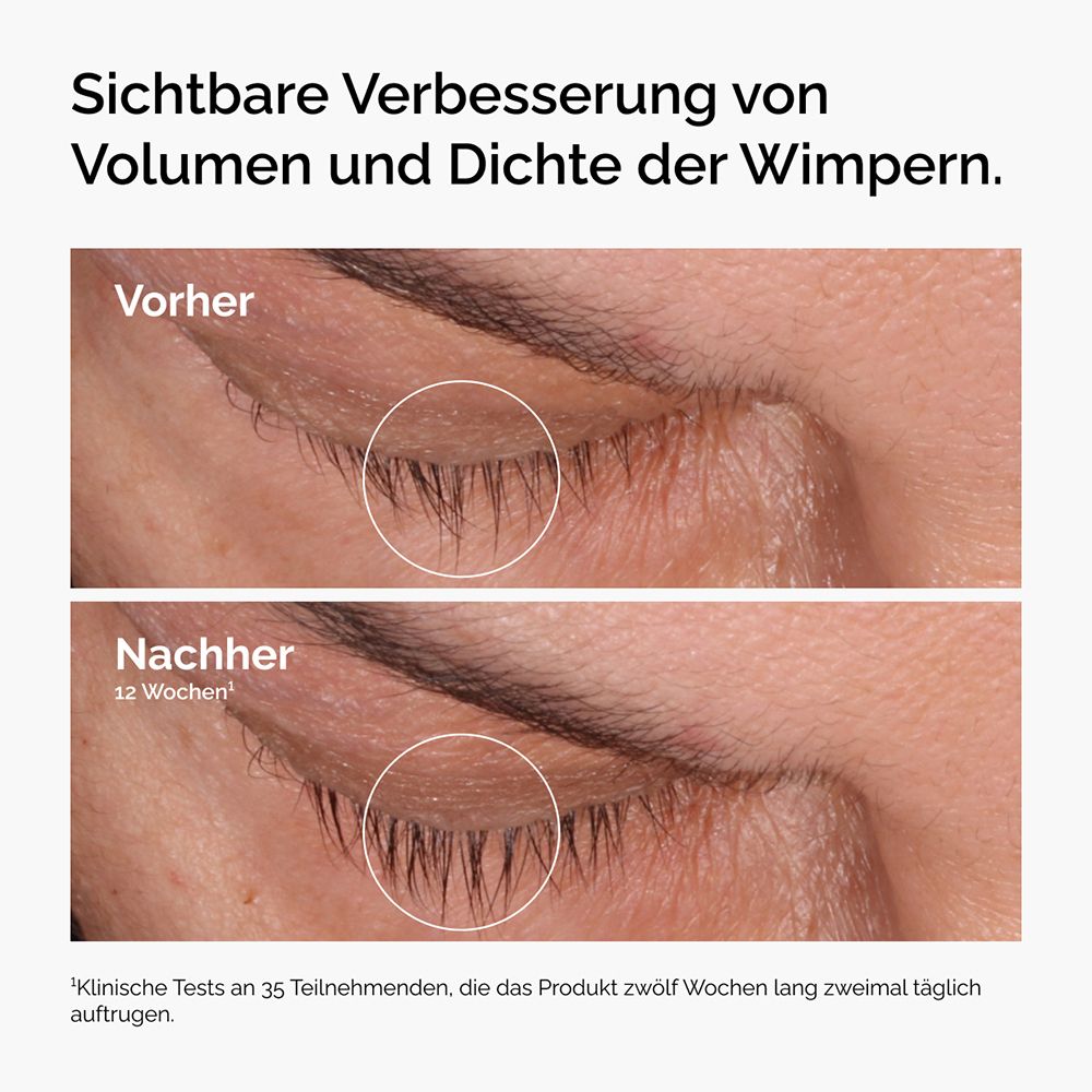 Vergelijking van wimpers voor en na 12 weken. Verbetering van de dichtheid.