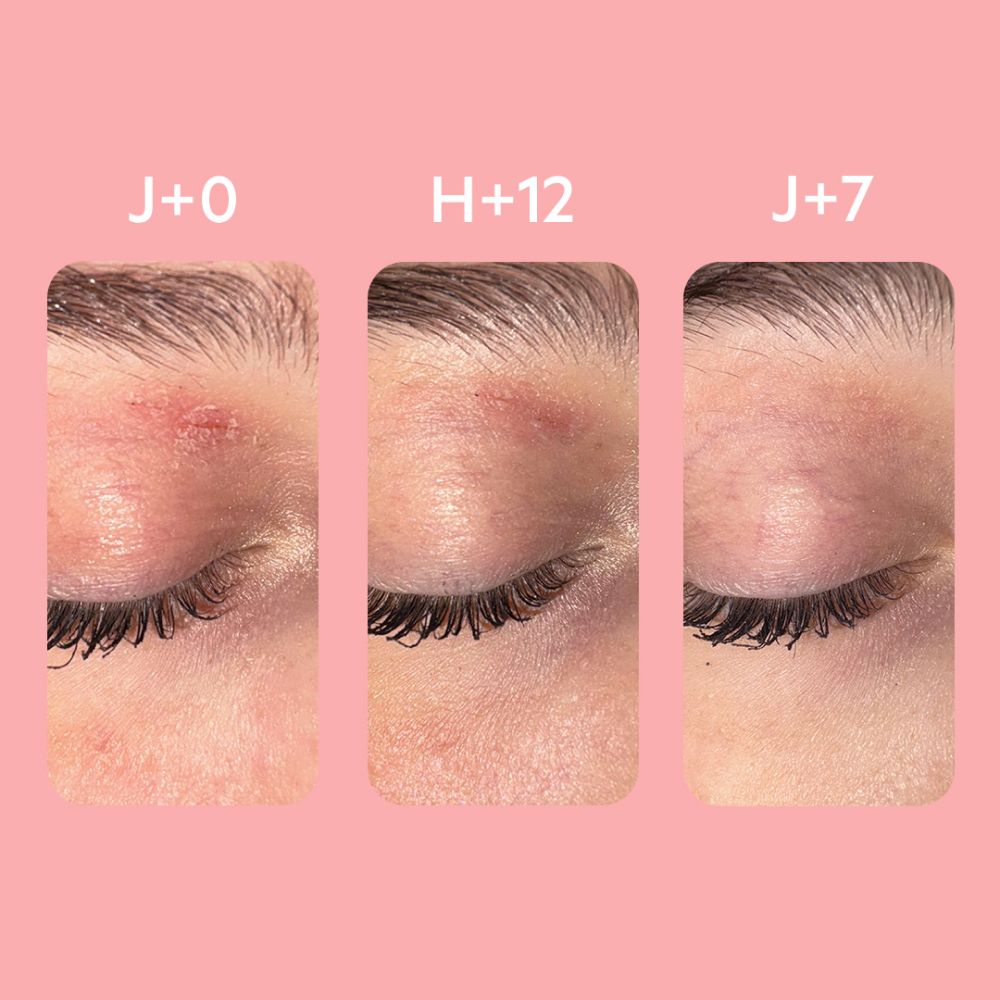 Drie afbeeldingen tonen oogleden. J+0, H+12, J+7. Roodheid verminderd. Roze achtergrond.