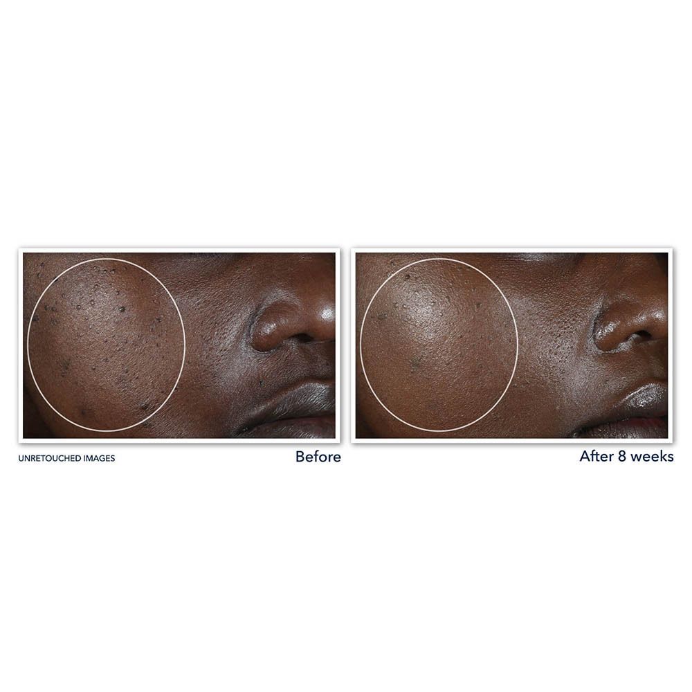 Images avant-après de visages. Cercles mettent en évidence des zones. Texte: Images non retouchées. Après 8 semaines.