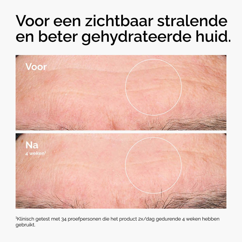Voor- en na-vergelijking. Huid met rimpels. Verbetering na 4 weken.