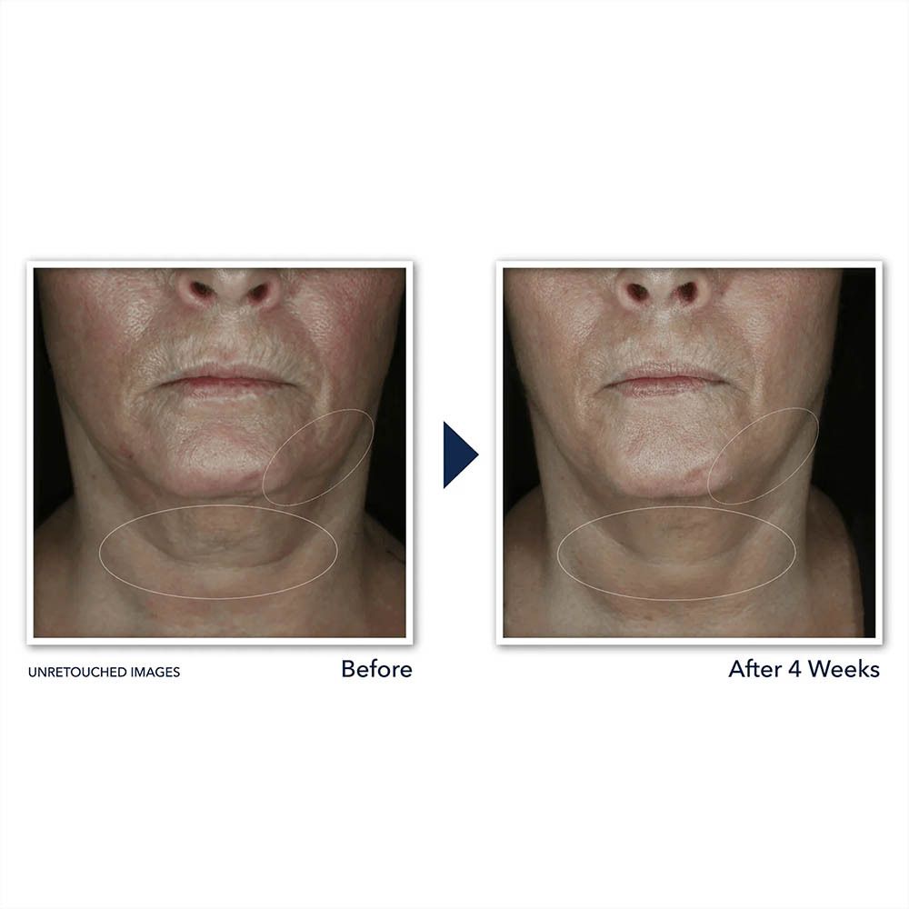 Images avant-après. Visage et cou. Zones marquées. Résultats après 4 semaines.