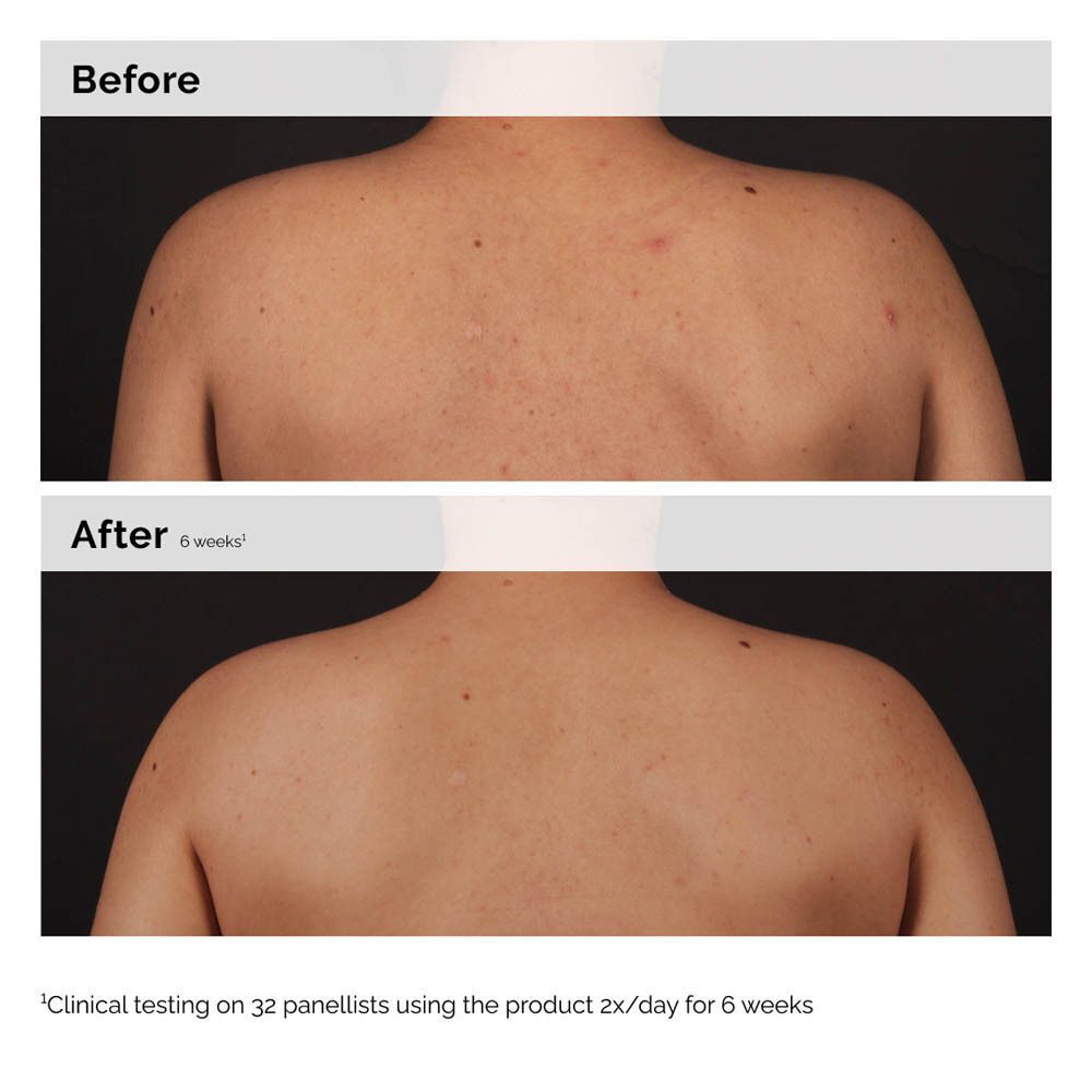 Vorher/Nachher-Vergleich: Rücken mit Hautunreinheiten, dann verbesserte Haut nach 6 Wochen.