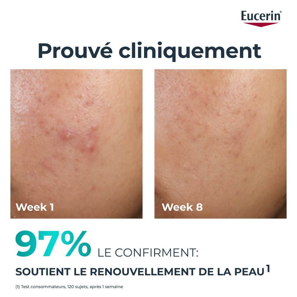 Voor-en-na-afbeelding. Gezicht met acne. Week 1 en week 8. Tekst: 97% bevestigen huidvernieuwing.