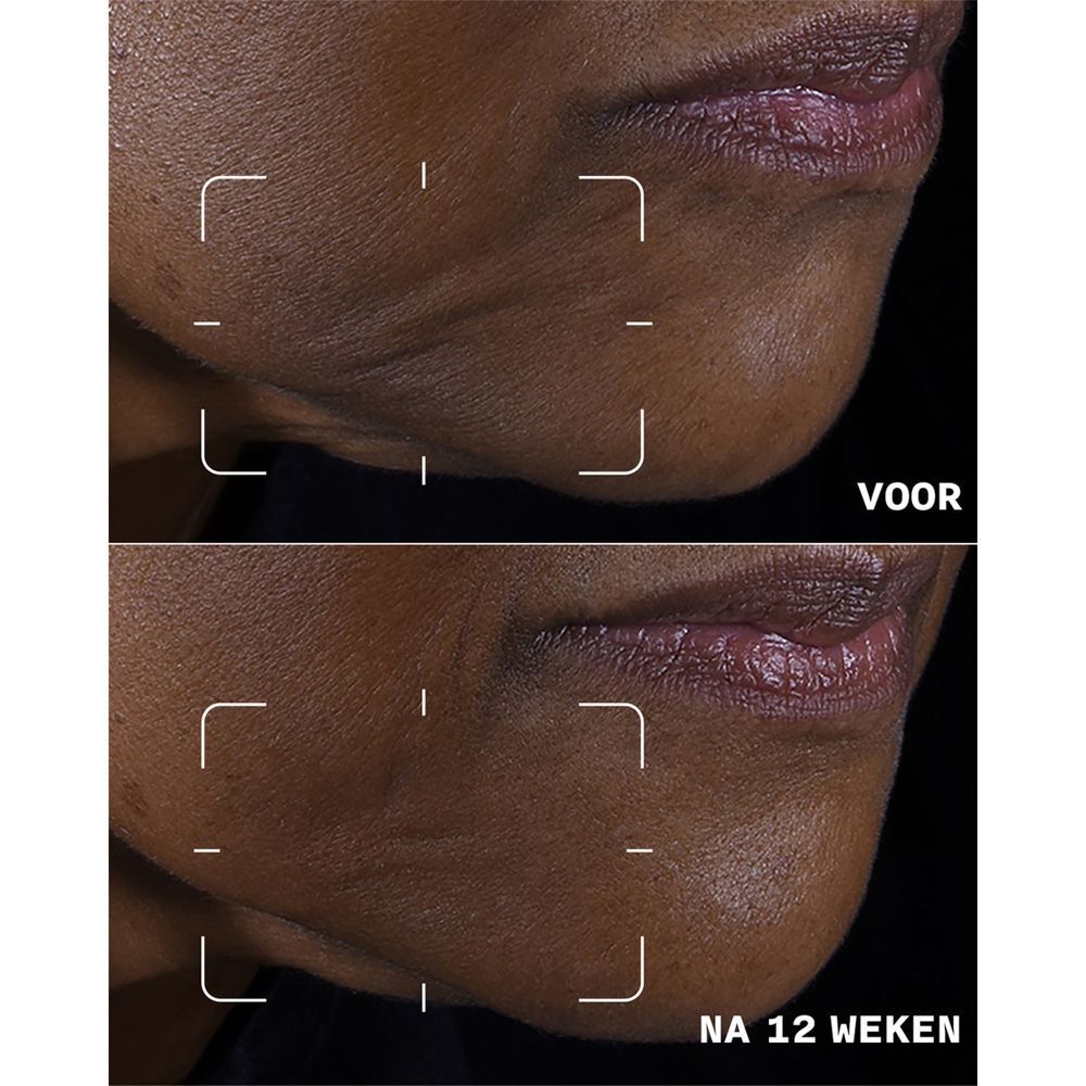 Vorher-Nachher-Vergleich der Haut am Kinn, der die Wirkung von Clinique Smart Clinical Repair zeigt.