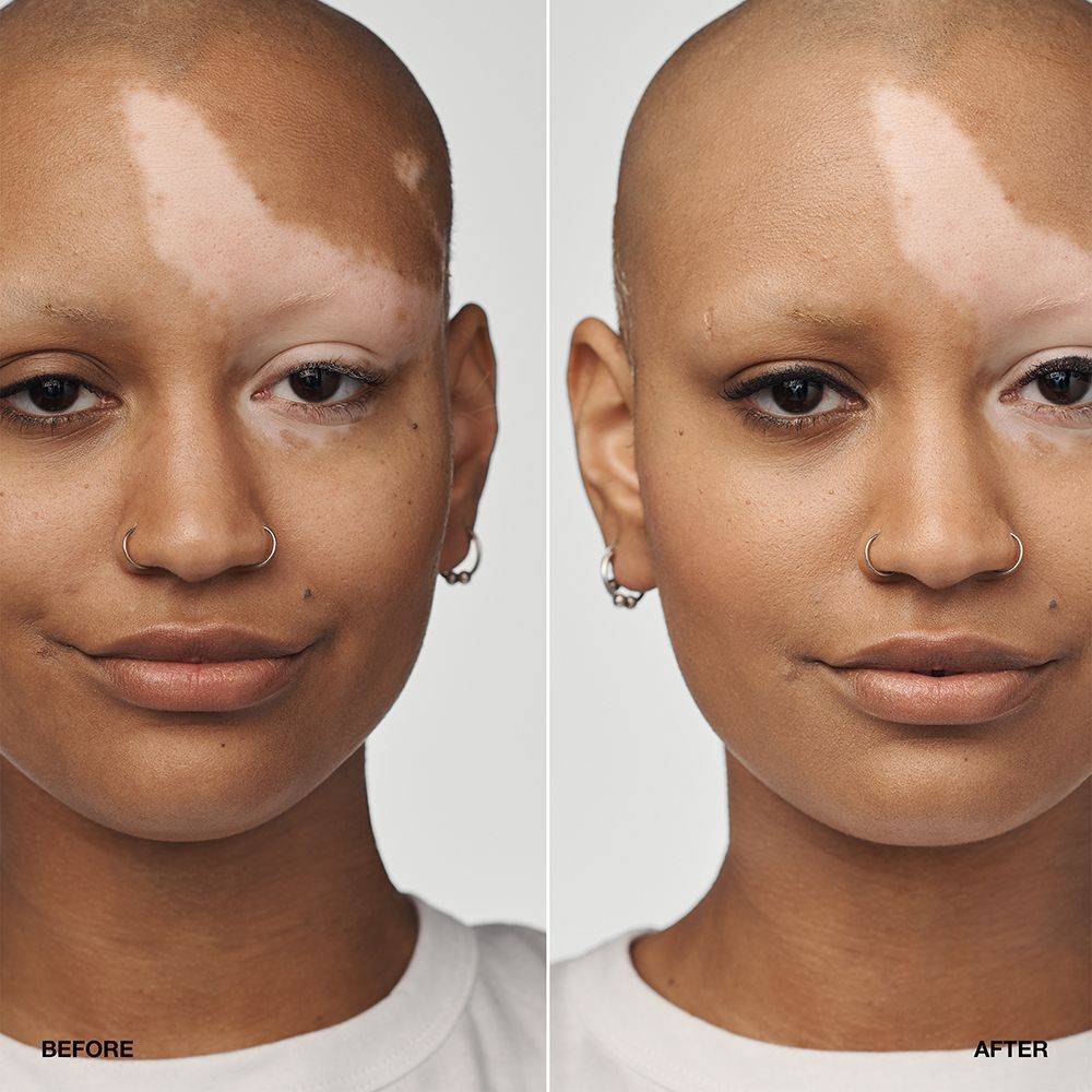 Vorher-Nachher-Vergleich einer Person mit Vitiligo, die Clinique Even Better Clinical Serum Foundation trägt.