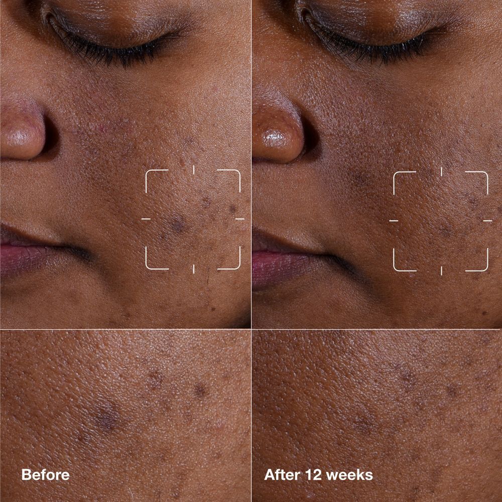 Vorher/Nachher-Vergleich der Haut mit Pigmentflecken, behandelt mit Clinique Even Better Clinical™ Serum.
