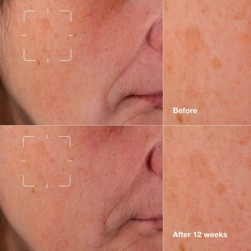 Vorher/Nachher-Vergleich der Haut mit Pigmentflecken, behandelt mit Clinique Even Better Clinical™ Serum.