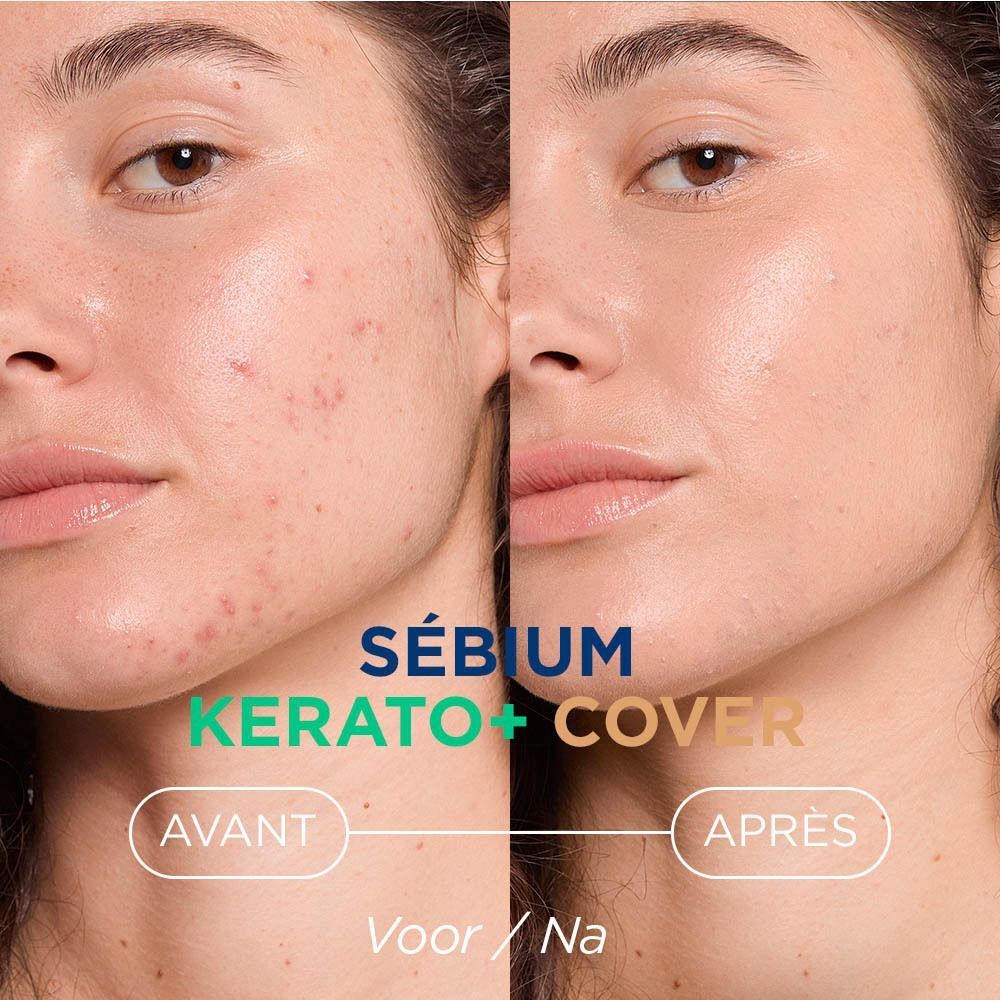 Comparaison avant/après d'une peau acnéique et d'une peau améliorée. Texte : Sébium Kerato+ Cover.