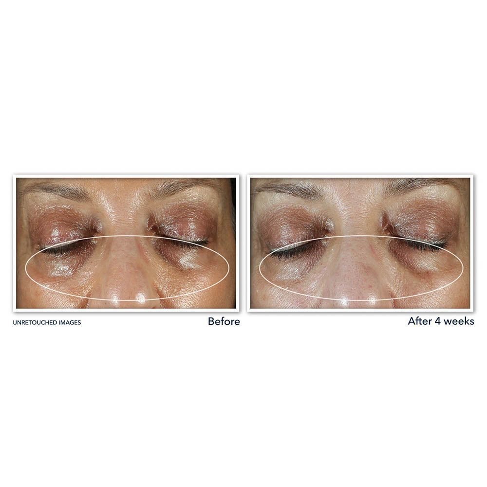 Images avant-après de la zone des yeux après 4 semaines.