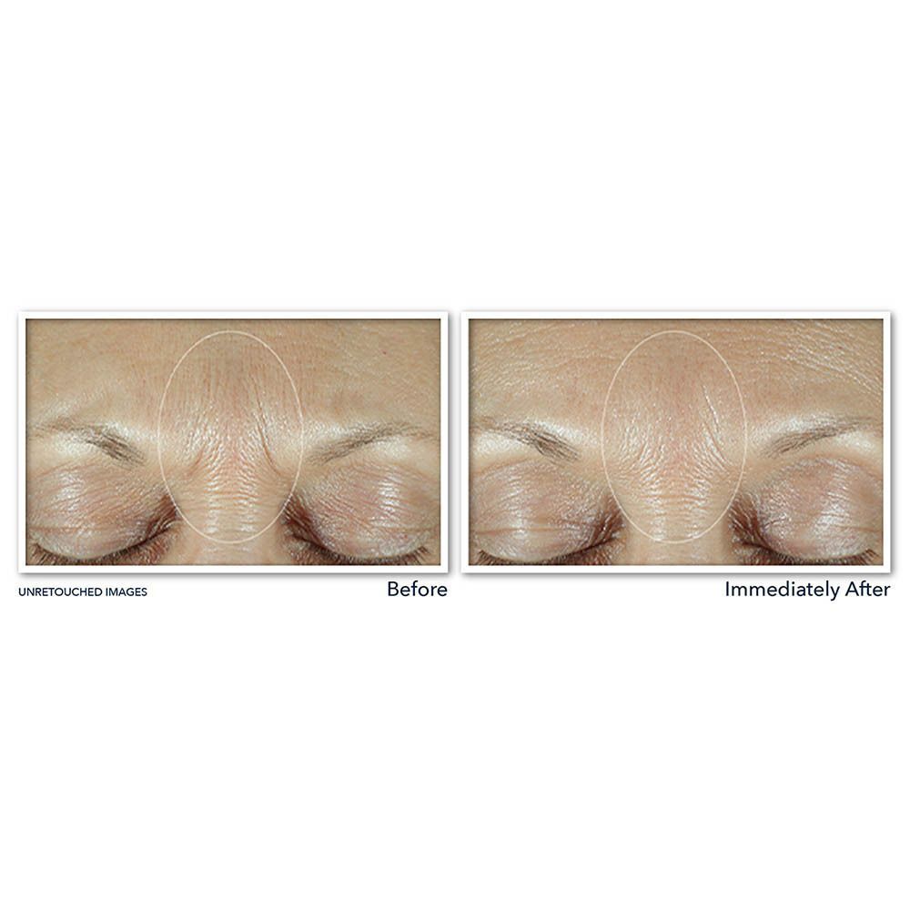 RoC Derm Correxion Sérum Fill + Treat