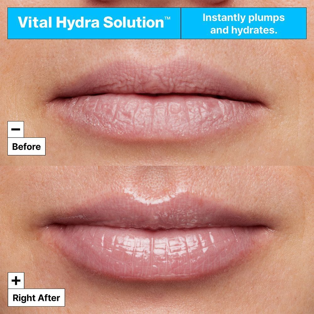 Vorher/Nachher-Vergleich von Lippen, die durch Vital Hydra Solution aufgepolstert und hydriert wurden.