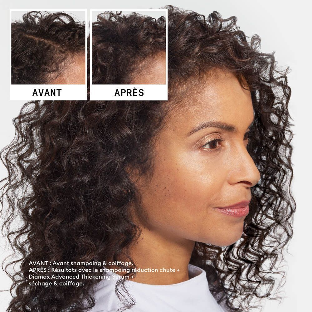 Comparaison avant-après de cheveux clairsemés. Gauche : Avant. Droite : Après.