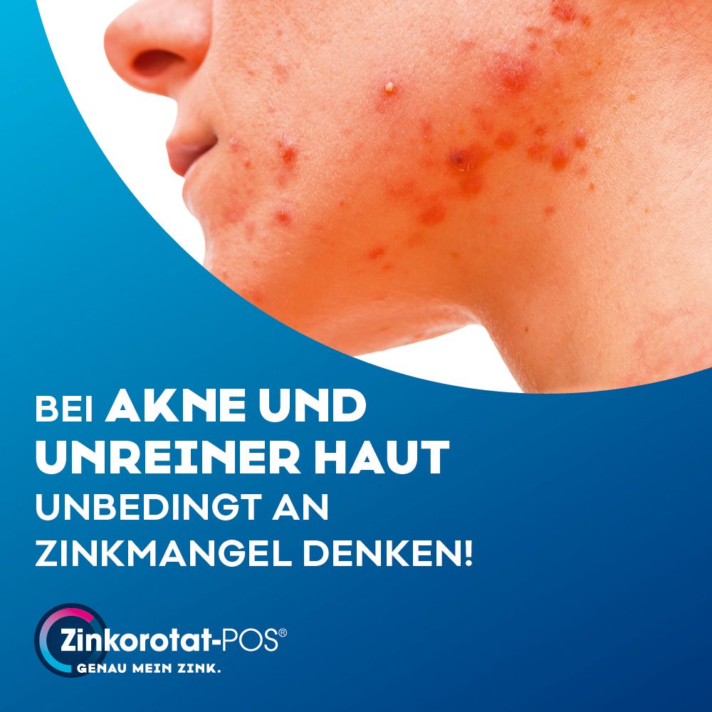 Gesicht mit Akne. Text: Bei Akne und unreiner Haut unbedingt an Zinkmangel denken! Zinkorotat-POS® Logo.