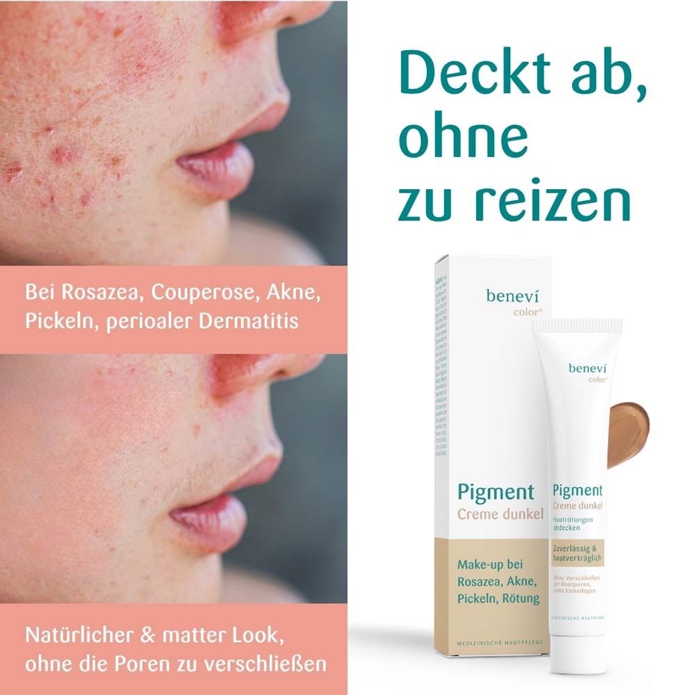 Pigmentcreme dunkel, Tube und Verpackung. Text: Deckt ab, ohne zu reizen. Bei Rosacea, Couperose, Akne, Pickeln, perioraler Dermatitis.
