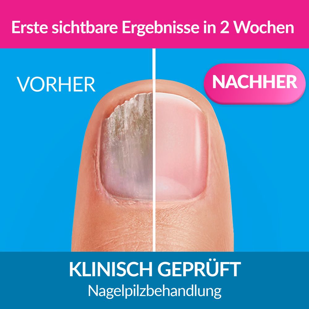 Vorher-Nachher-Vergleich eines Nagels mit Nagelpilz, behandelt mit Excilor.