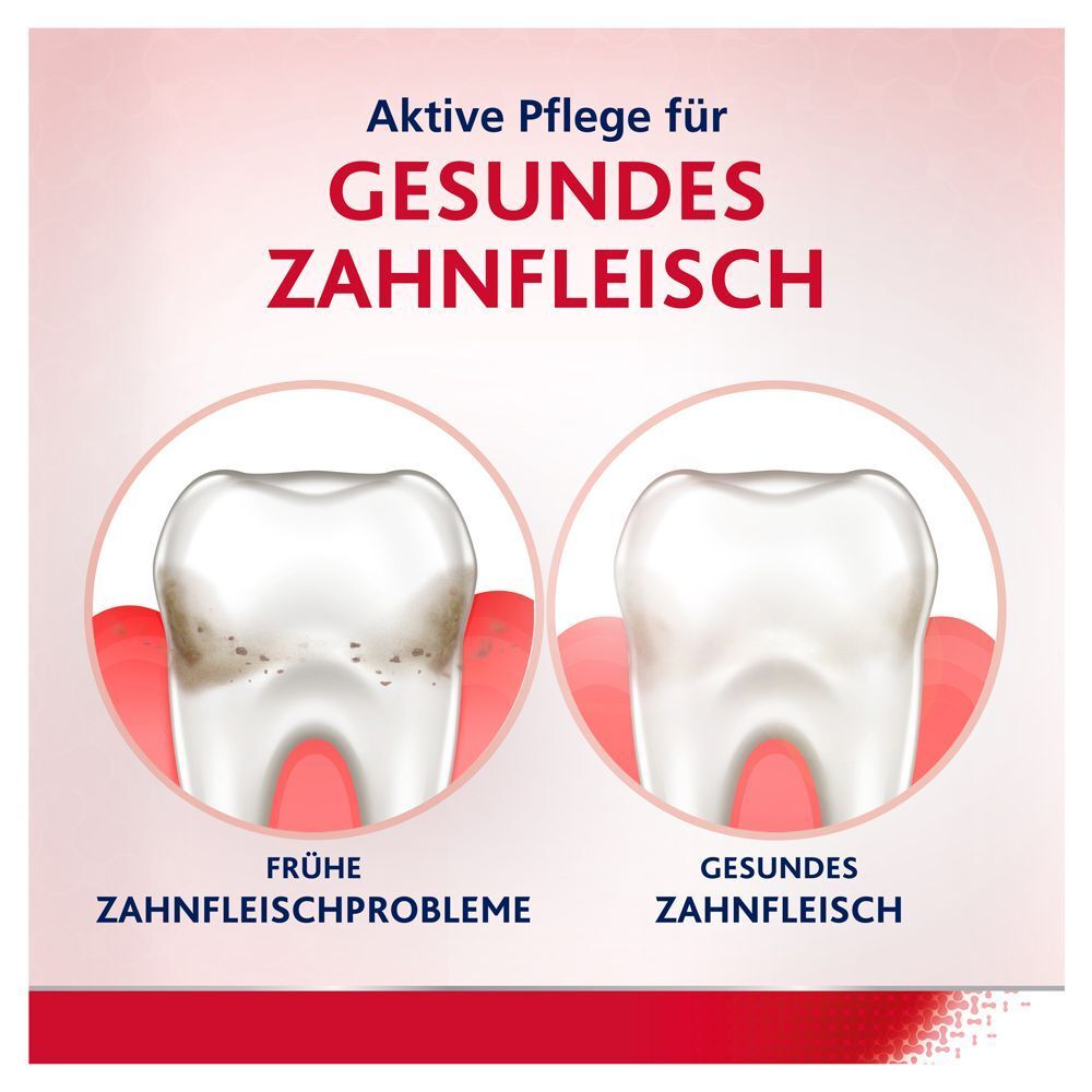 Vergleich von Zähnen: links frühe Zahnfleischprobleme, rechts gesundes Zahnfleisch.