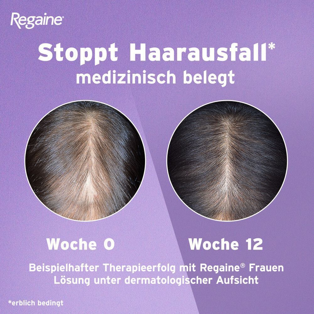 Vergleich zweier Kopfhautansichten vor und nach 12 Wochen Behandlung.