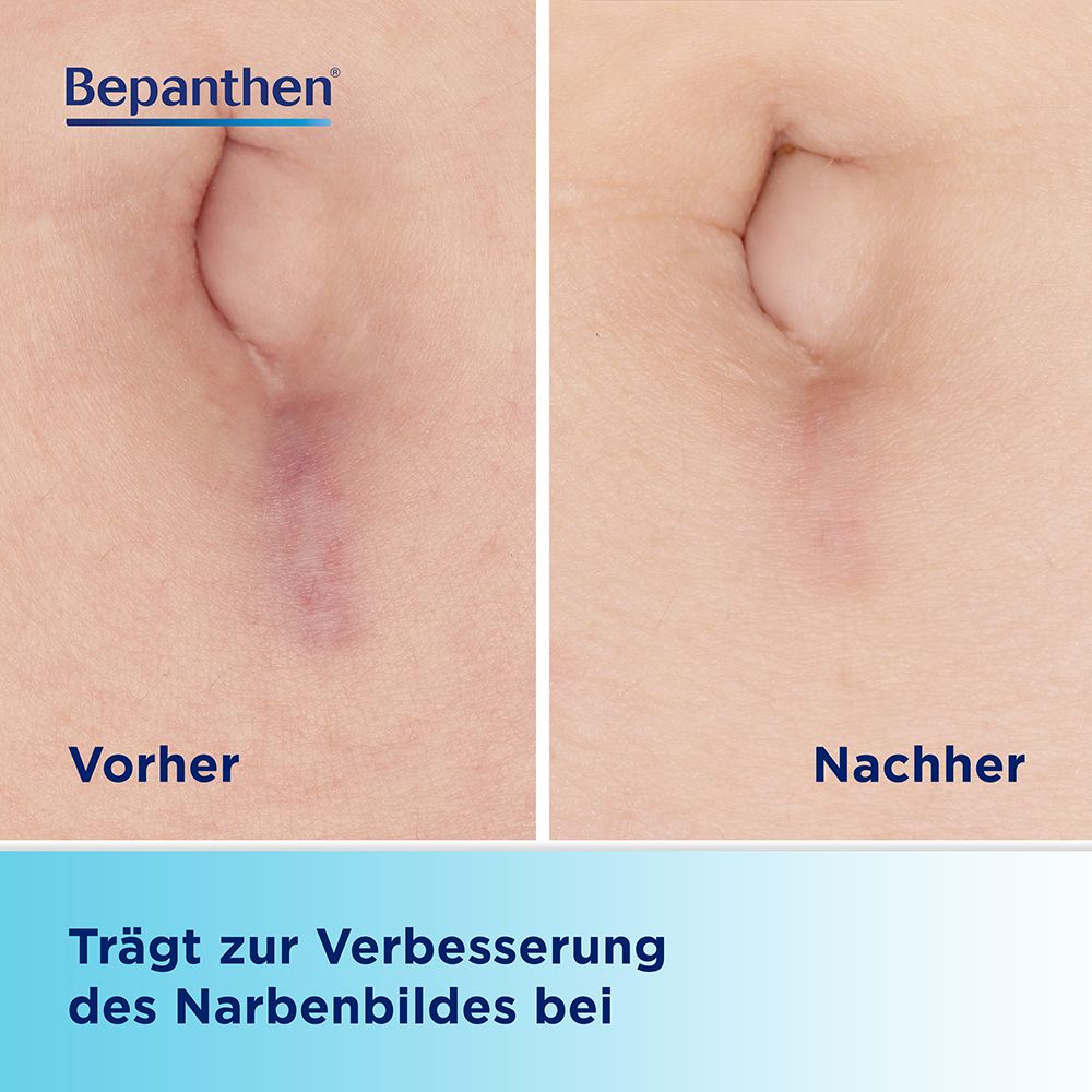 Bauch mit Narbe vor und nach der Behandlung. Text: Trägt zur Verbesserung des Narbenbildes bei.