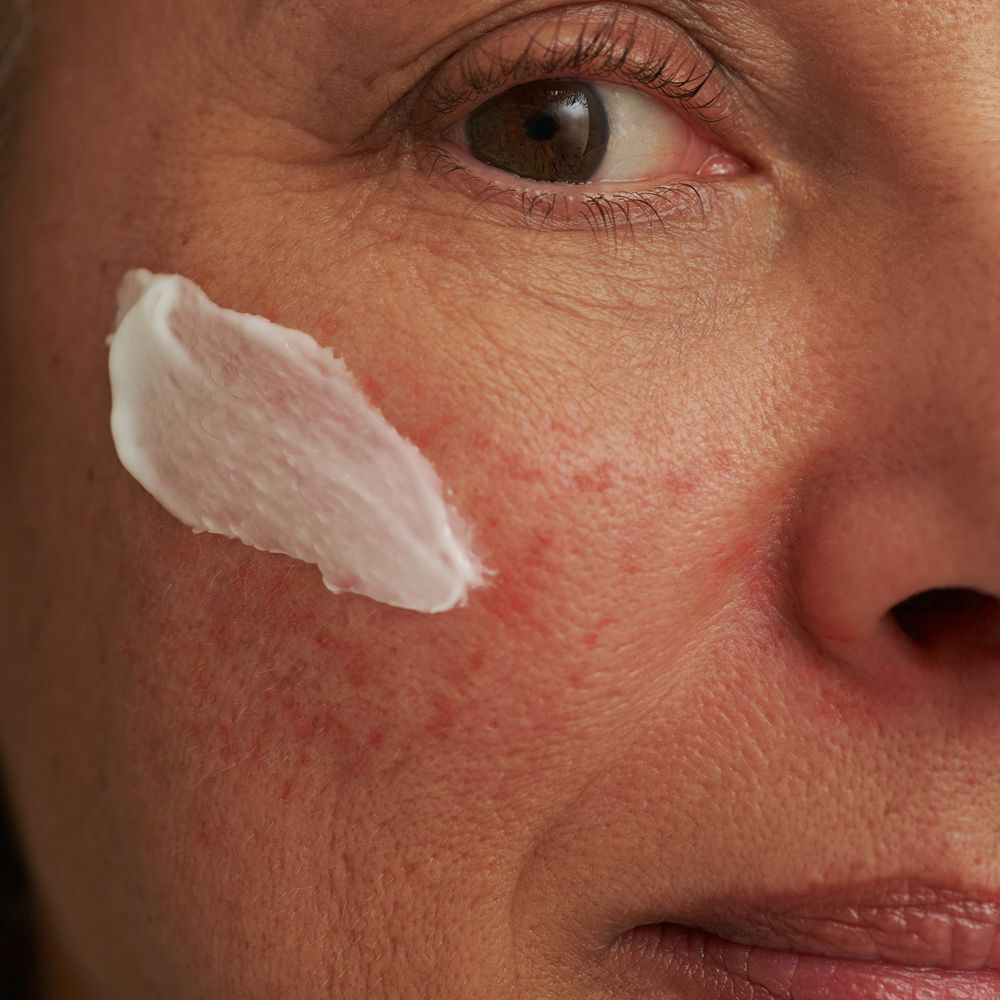 Creme auf geröteter Haut mit Rosacea-Symptomen, Nahaufnahme.