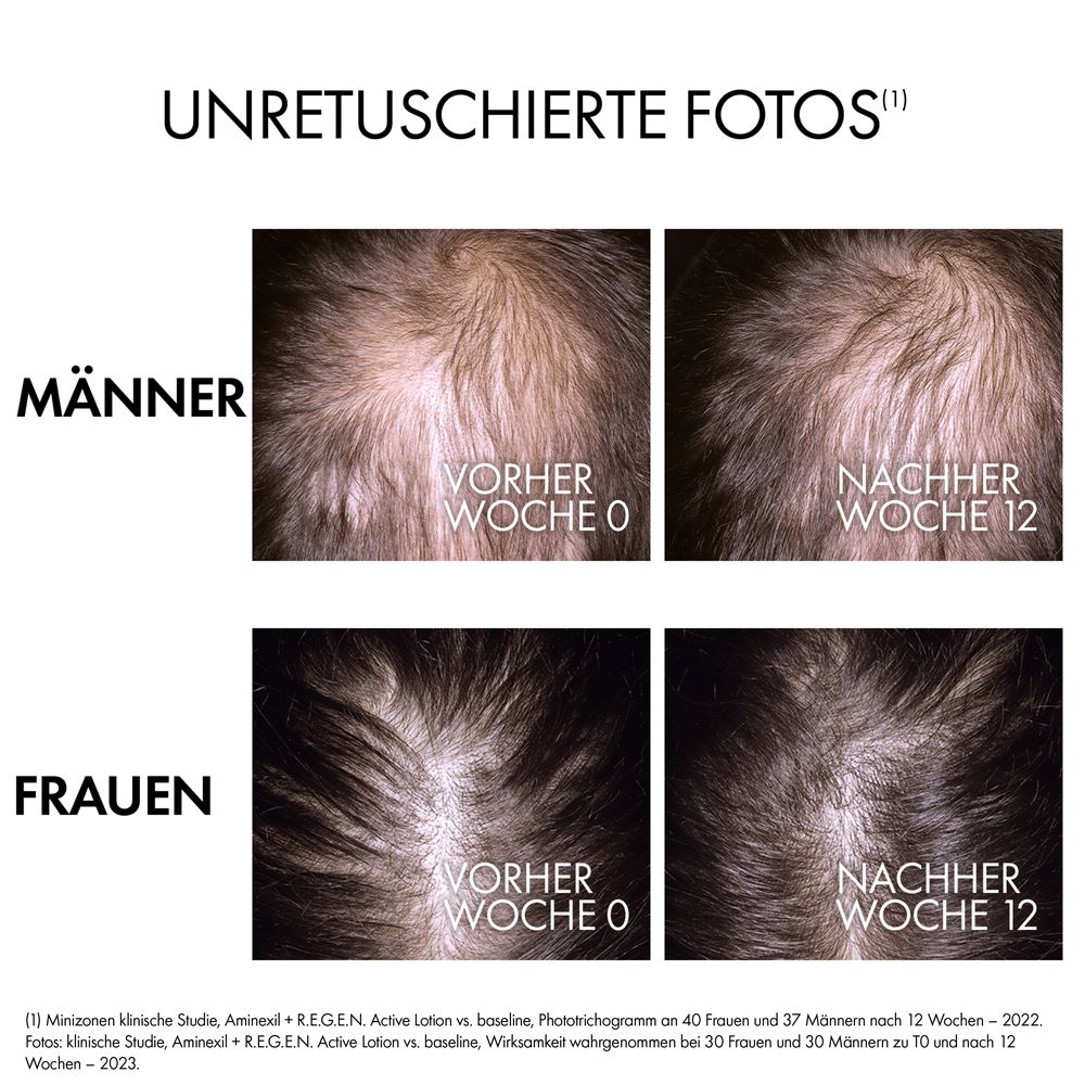 Vorher-Nachher-Vergleich von Männer- und Frauenhaar. Fotos zeigen Kopfhaut vor und nach 12 Wochen. Text: 'UNRETUSCHIERTE FOTOS'.
