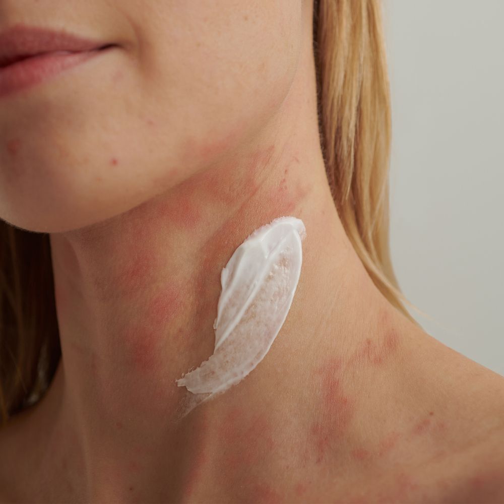 Creme auf dem Hals einer Person mit Hautrötungen.