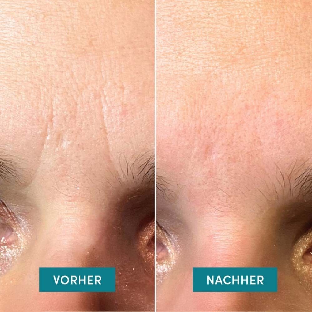 Vorher-Nachher-Vergleich. Links: gerunzelte Stirn. Rechts: glatte Stirn. Text: Vorher, Nachher.